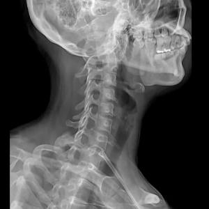 Цифровой рентген аппарат 6600 Генератор 56kW Siemens трубка