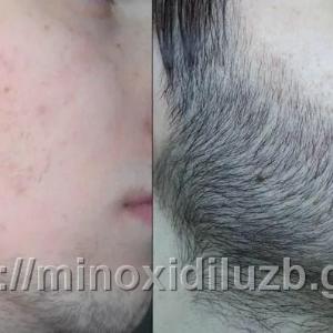 Kirkland Minoxidil 5% Средство для роста волос